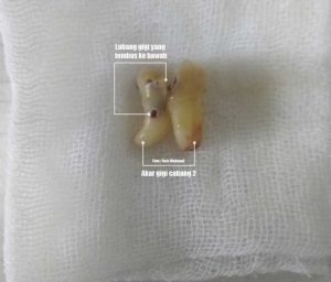 Cabut gigi saat sakit asam lambung