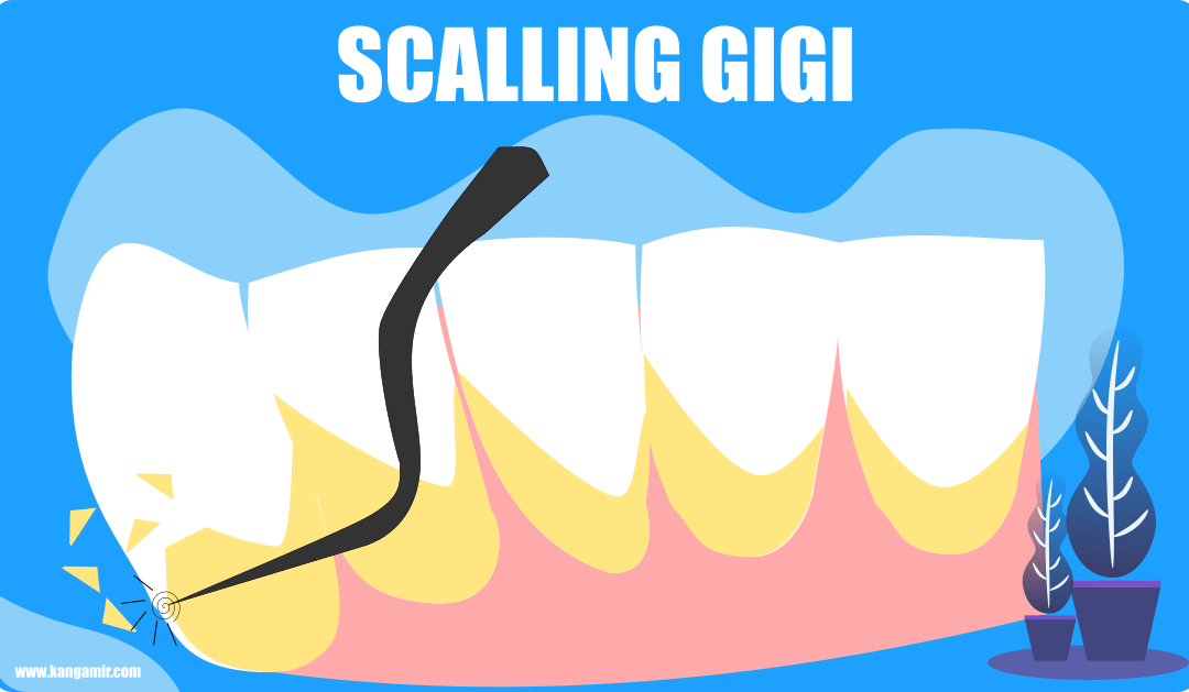 2 Kali Scalling – Ini Pengalaman Saya Membersihkan Karang Gigi di Dokter Gigi