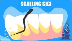Scalling, pembersihan karang gigi